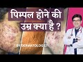 Is Acne Only Teenagers Problem Kya Acne Teenage Me Hi Hote Hai Pimple Hone Ki Umar Kitni Hai