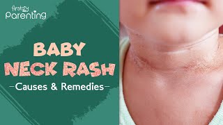 Neck Rash in Babies -  Causes, Signs and Treatment