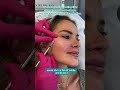 Cheek Filler Face Lift