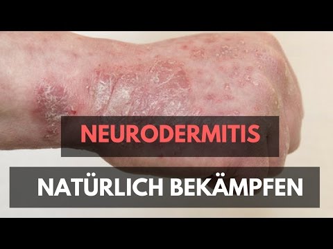 Moknuschtschaja ist das Ekzem ansteckend Wie nejrodermit auf den Beinen zu heilen
