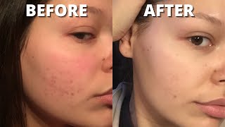 How to get rid of acne scars and fade dark spots & hyperpigmentation on the face