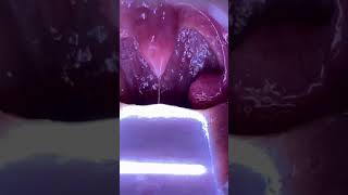 Download lagu Tonsillar Cancer Lesion - Captured with TelScope Telehealth System Intraoral Camera mp3