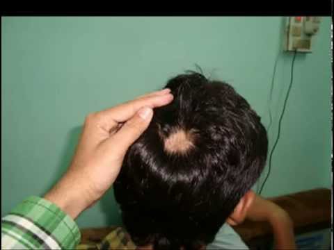 , title : 'Alopecia, una enfermedad que afecta a cerca del 2% de la población mundial'