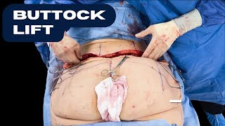 Revision Body Lift + Thigh Lift and Reduction