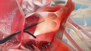 Step-by-Step: How 4D ICE supports PFA and LAAC procedures