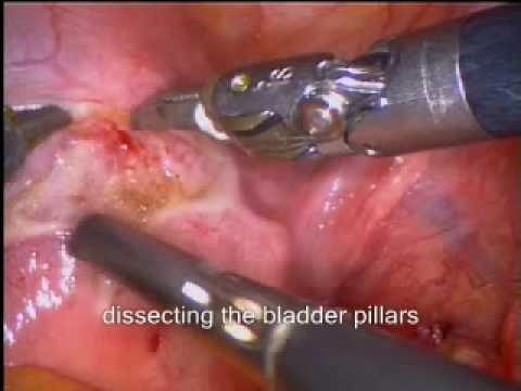 Pelvic Floor Correction By Laparoscopic Uterus Excision (Supracervically)