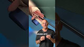 Bone-on-Titanium for ⬆️ Function, ⬇️ Complications #shorts