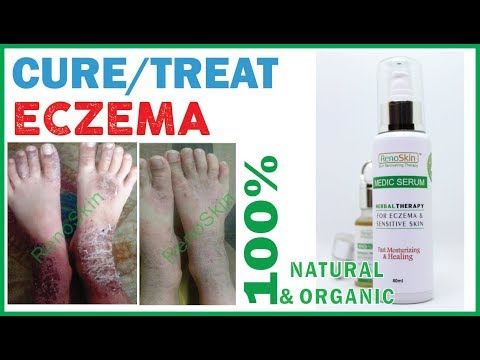 Se è neurodermatitis infettivo Localizzazione di dermatite di atopic
