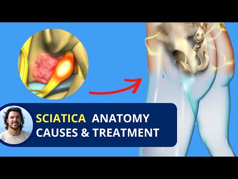 Sciatica Nerve Pain Causes and Treatment | Anatomy L4-L5-S1
