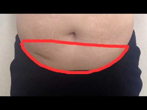 กระแทกหน้าอกหลังจาก mammoplasty ผู้หญิง enlarge หน้าอก