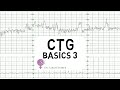 CTG Basics Part 3 - Overall Assessment & Examples