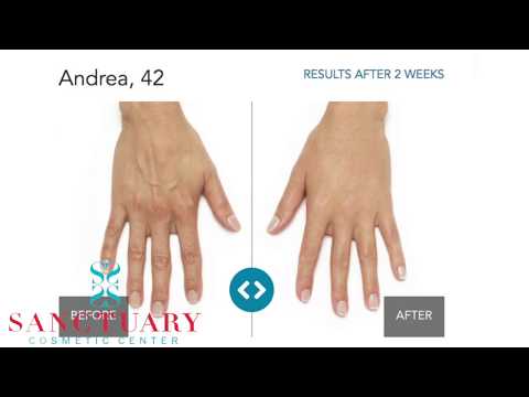 Anti-aging Treatments for Your Hands-Stop the aging