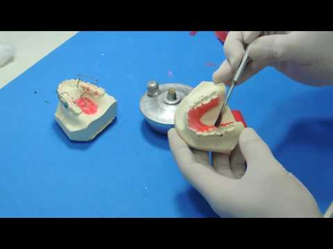 Bionator - Alívios com cera