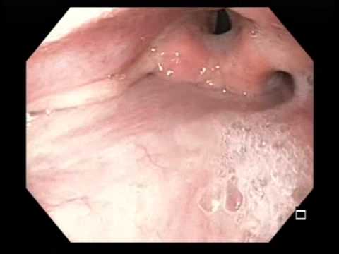 Normal Airway and Nasal Trumpet