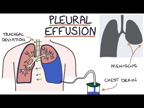 Understanding Pleural Effusions