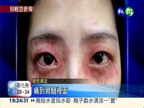 刷牙血流不止 當心紫斑症作祟