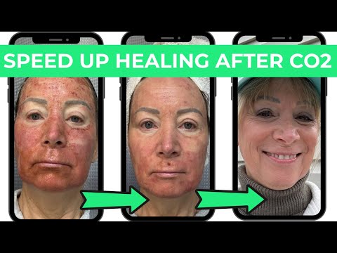Wie kann ich die Heilung nach einer CO2-Laserbehandlung beschleunigen? Wie lange dauert es nach e...