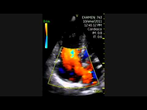 Atrial Septal Defect