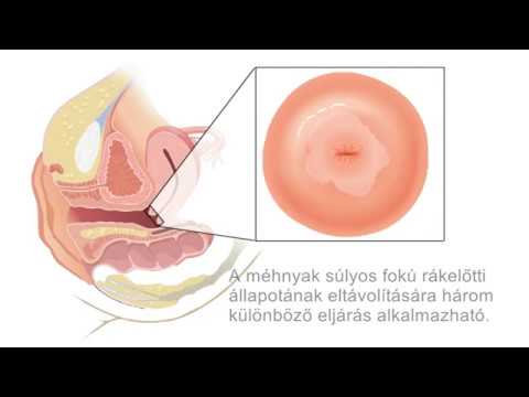 Giardia terhesség alatt