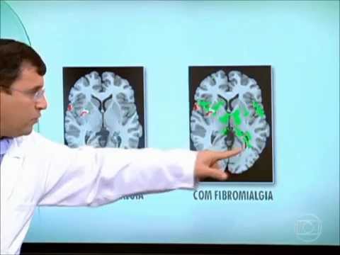 Fibromialgia- Programa Bem Estar