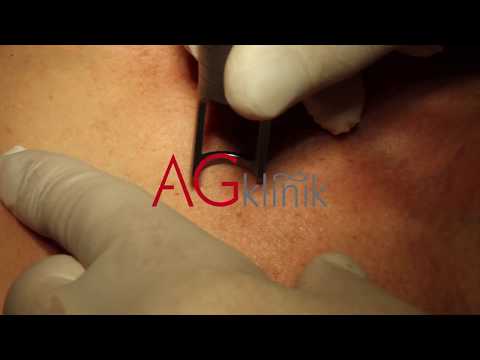 Laserowe usuwanie przebarwień na skórze w AG Klinik