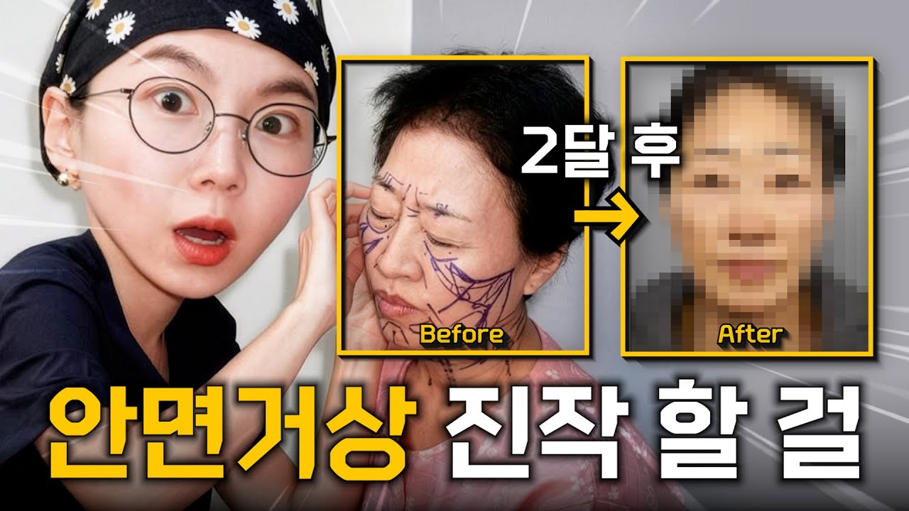 2달 만에 이 얼굴? 안면거상, 진짜 이 정도라고요?