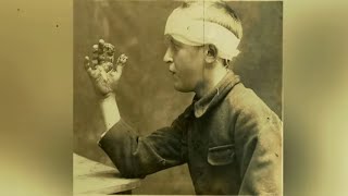 Unsettling WW1 Horrific Injury And Wound Photos You&#39;re Not Allowed To See