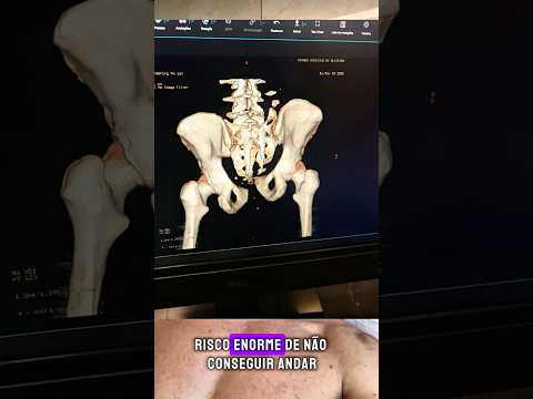 acidente que sofri em um parque aquático na cidade de ITAIPULANDIA Paraná.