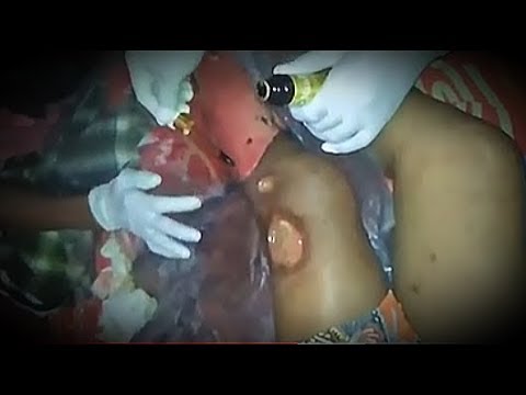 Was Rate von Zucker bei Diabetikern Eiche Eicheln von Diabetes