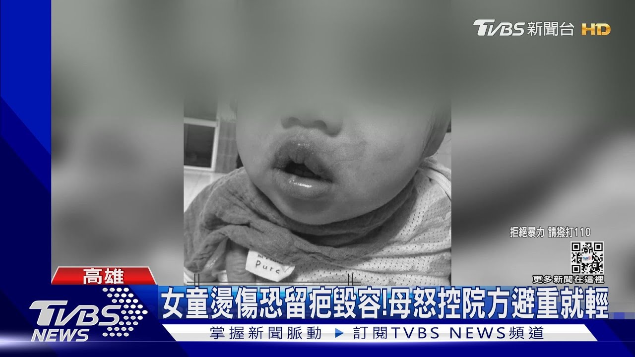 控師燙傷1歲女兒嘴唇! 母首出面曝最新傷勢 恐毀容