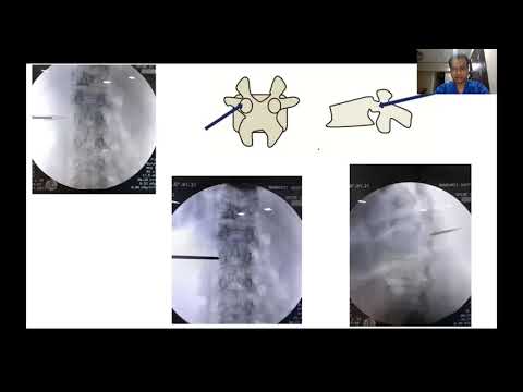 Percutaneous Verteberoplasty - Dr Nikhil Arbatti