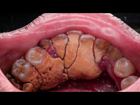 UNBELIEVABLY GIGANTIC TARTAR | KARANG GIGI | Dentist | Dokter Gigi Tri Putra