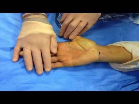 comment soulager syndrome de morton