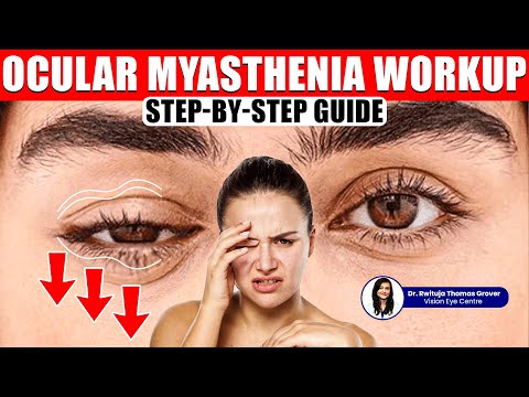 Ocular Myasthenia Treatment | Step-by-Step Guide
