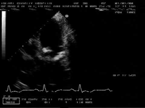 Cardiac Calcification In Chronic Kidney Failure With Hyperparathyroidism