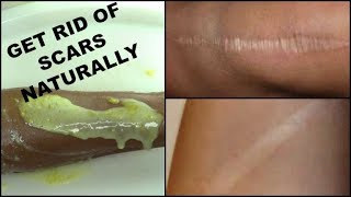 WATCH YOUR SCARS DISAPPEAR IN JUST A FEW WEEKS, 2 STEPS SCARS REMOVER REMEDY |Khichi Beauty