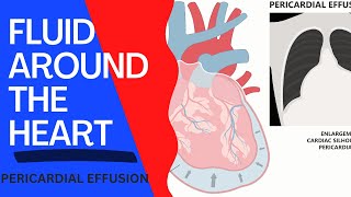 Fluid Around The Heart (Pericardial Effusion): Basic facts | Pericardiocentesis | Cardiac tamponade