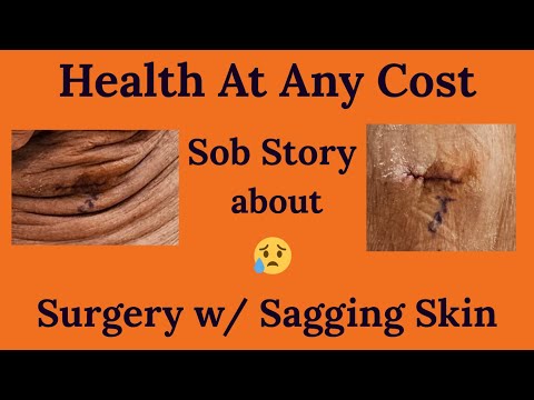 Sagging Skin from 280 Lbs. Weight Loss Gets in the Way of Surgery Healing