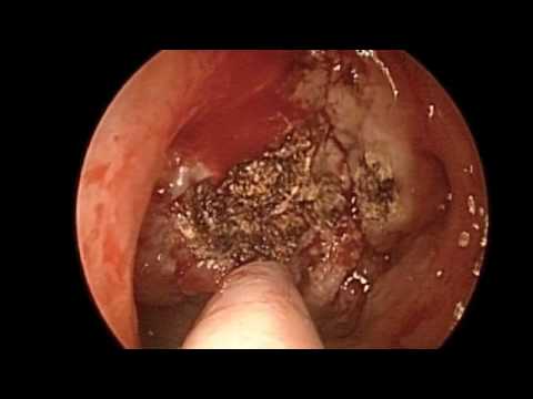 Two Caused of Nasal Obstruction and Methods of Treatment