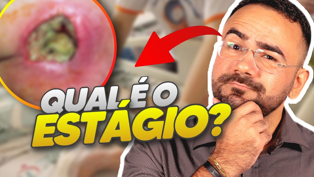 ATUALIZAÇÃO DA CLASSIFICAÇÃO DA LESÃO POR PRESSÃO: Como Classificar do jeito certo!