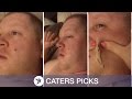 Il a un vieux bouton de 4 ans au visage, sa femme le perce enfin, mais ce qui sort de là est ignoble!