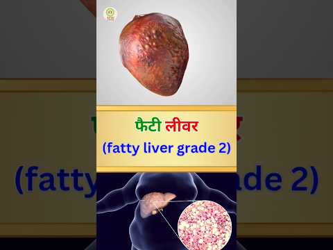 फेटी लिवर ( fatty liver grade 2) #mwayurveda #vaishaligirmile #heathtips #fattyliver #shorts