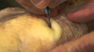 Understand Wound Care: Incision &amp; Drainage Demonstration