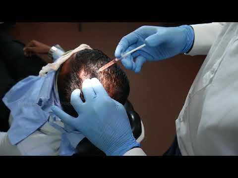 PRP Treatment - Platelet Rich Plasma For Hair Loss