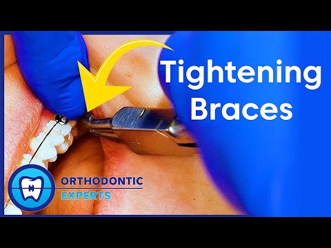 Tightening Braces | How & Why Of Changing Wires