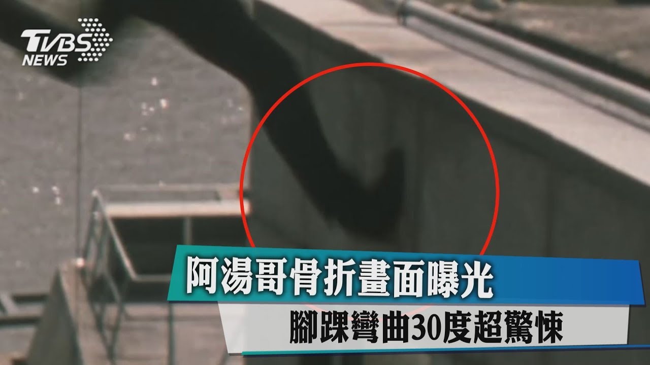 阿湯哥骨折畫面曝光　腳踝彎曲30度超驚悚