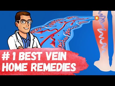 , title : '#1 Best Varicose Vein Home Remedies [Spider Veins in Legs Treatment]'