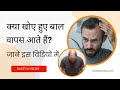 क्या खोए हुए बाल वापस आते हैं Hair Loss Treatment Hair