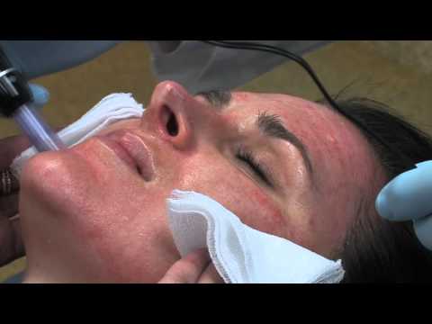 Dr. Mark B. Taylor Review of Dermapen Micro Needling @...