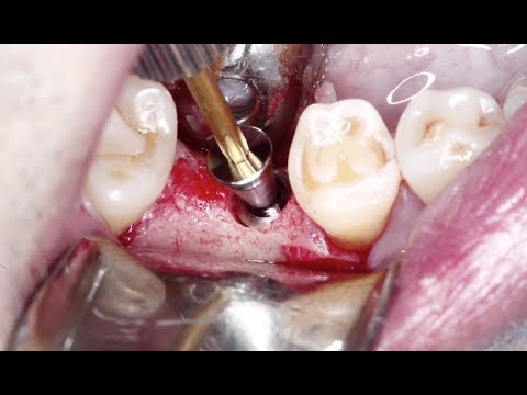 Case of the Week: A Straightforward Implant Case on Tooth #30